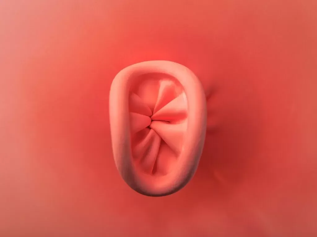 Ilustração demonstrando a aparência de um plicoma anal — excesso de pele ao redor da região anal
